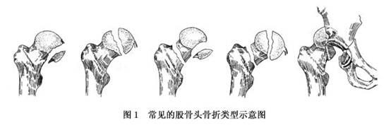 股骨头91免费看片增加是什么意思？平睡左腿收起左右摆动大点大腿根就痛。