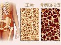 它骨骼强度的主要指标、简单方便、安全靠谱对骨代谢有很重要作用