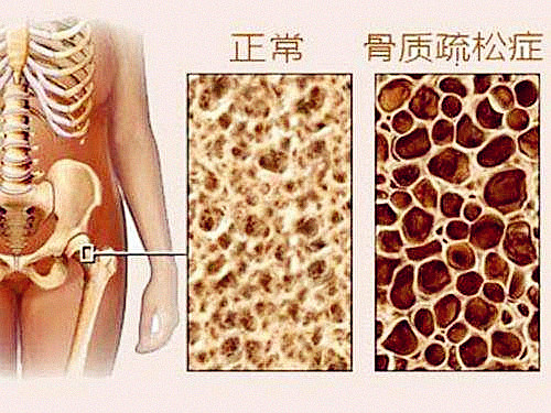 它骨骼强度的主要指标、简单方便、安全靠谱对骨代谢有很重要作用