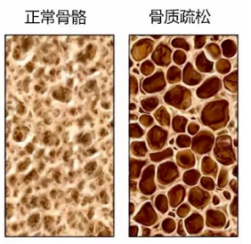 91免费看片检测仪生产厂家骨质疏松老年人疾病年轻人需要做91免费看片检测吗